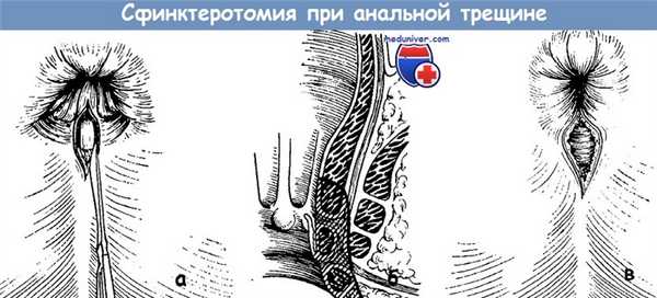 Сфинктеротомия при анальной трещине