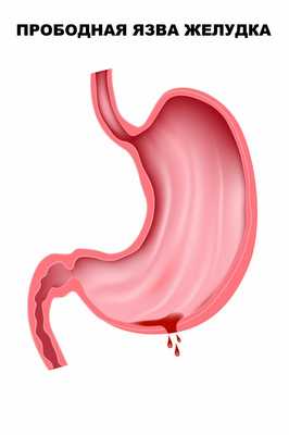 Острый живот