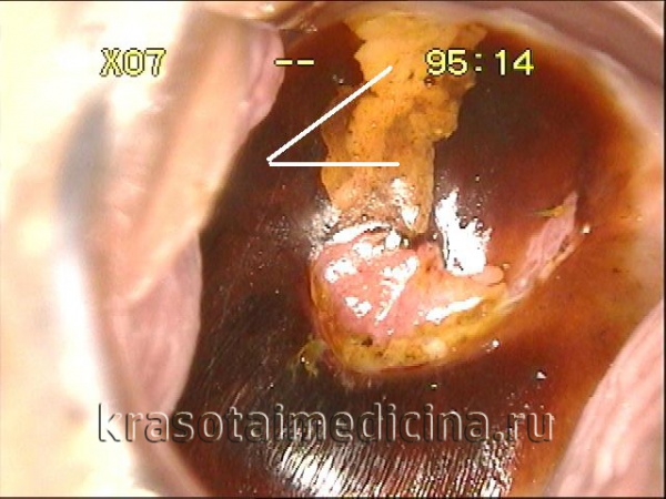Кольпоскопия, проба Шиллера. Участок дисплазии шейки матки (предракового состояния)