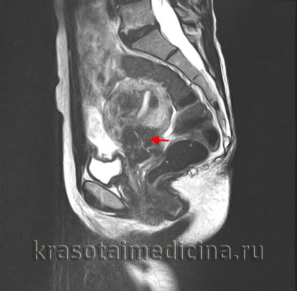 Предраковые заболевания шейки матки