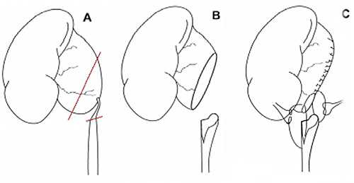 Операция при гидронефрозе
