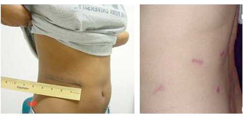 Операция при гидронефрозе