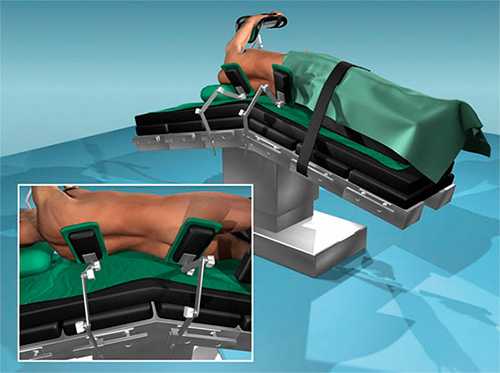 Операция при гидронефрозе