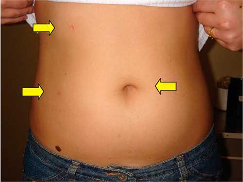 Операция при гидронефрозе