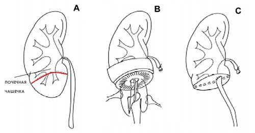 Операция при гидронефрозе