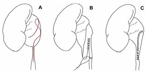 Операция при гидронефрозе
