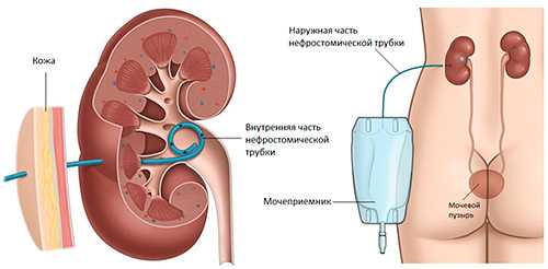 Операция при гидронефрозе