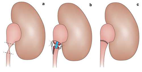 Операция при гидронефрозе