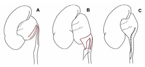 Операция при гидронефрозе