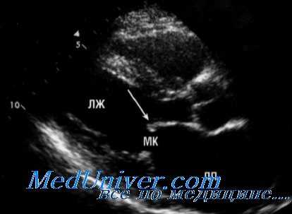 лекарственное поражение митрального клапана