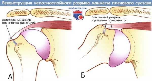 Реконструкция неполнослойного разрыва вращательной манжеты плечевого сустава