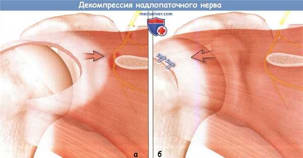 Декомпрессия надлопаточного нерва при нейропатии