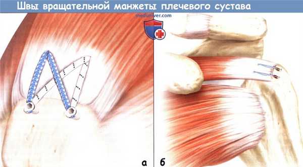 Швы вращательной манжеты плечевого сустава