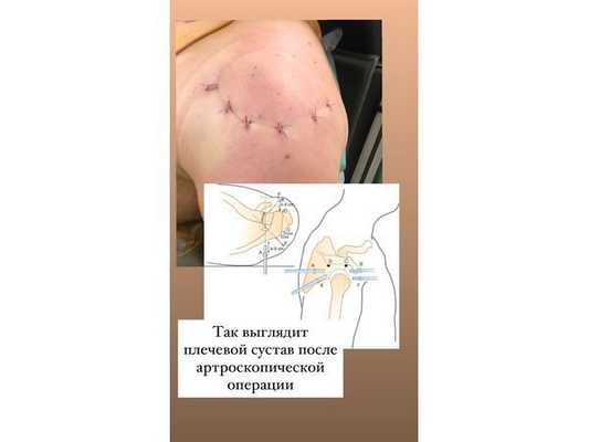 Заживление раны после операции