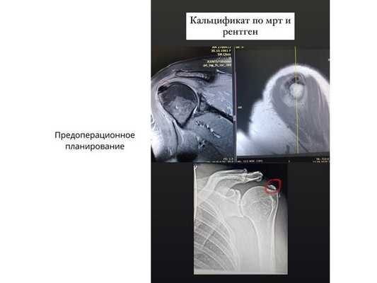 Инструментальное обследование сухожилия