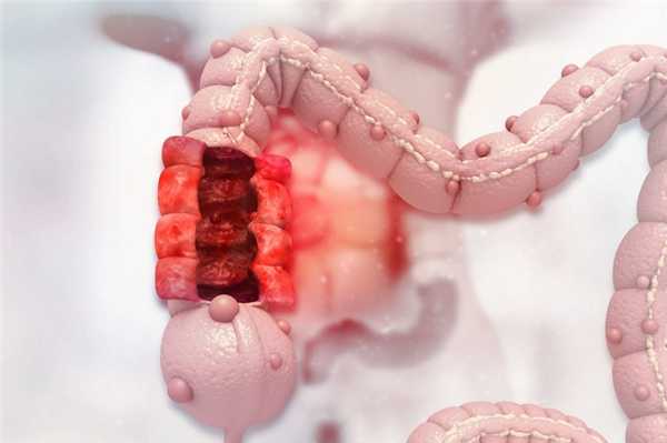 Перфорация кишечника