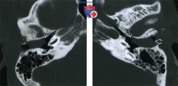 Обтурирующий кератоз (ОК) - лучевая диагностика
