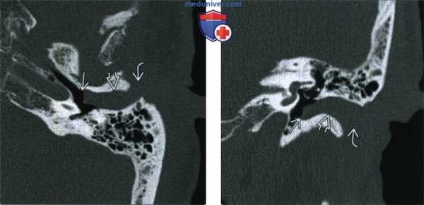 Обтурирующий кератоз (ОК) - лучевая диагностика