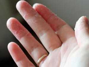 Гиперкератоз