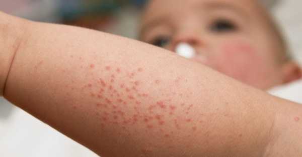 Фолликулярный гиперкератоз