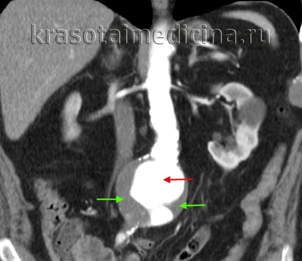 Аневризма аорты