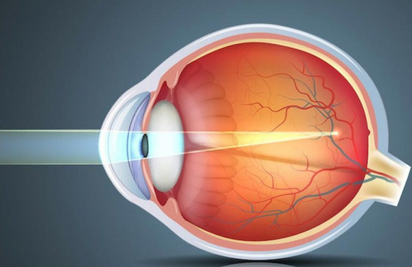 Аномалии рефракции