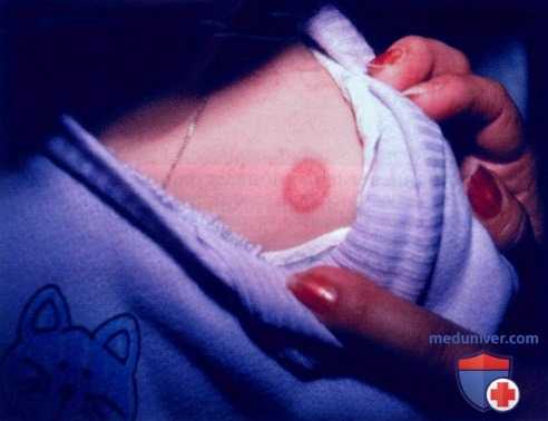 Дерматофития гладкой кожи