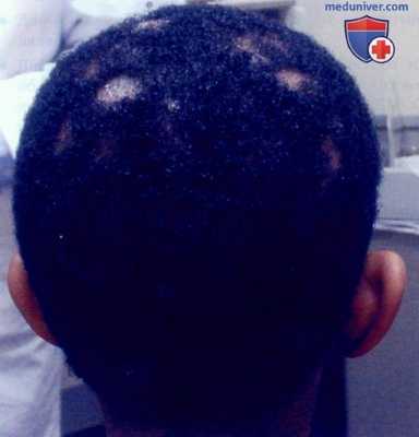 Дерматофития волосистой части головы