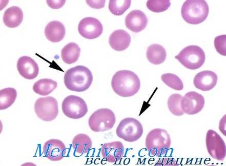 гемоглобинопатии