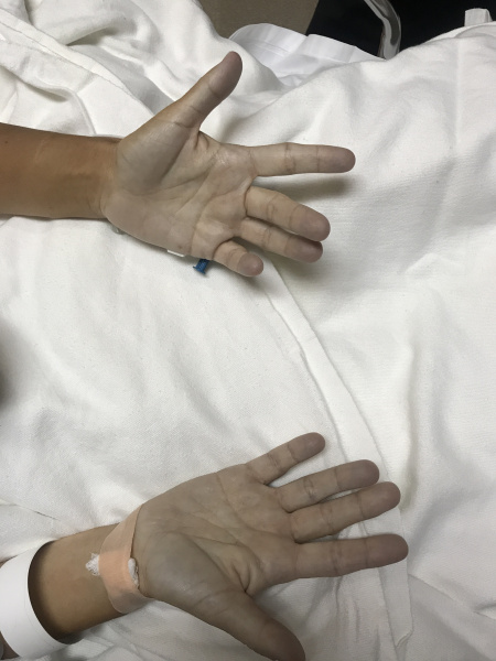 Сероватый цвет кожных покровов при метгемоглобинемии