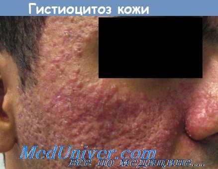 гистиоцитоз