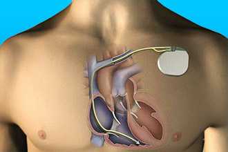 Имплантация кардиостимулятора пациентам с ГКМП