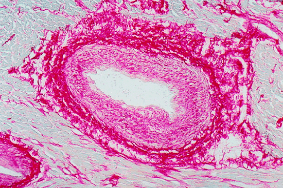 Причины, признаки, методы лечения кардиомиопатии