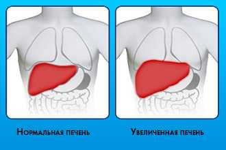 увеличение печени при обследовании пациентов с кардиомиопатией