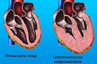 Гипертрофическая кардиомиопатия (ГКМП)