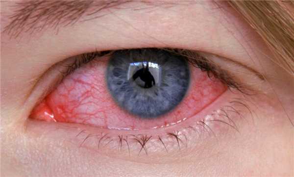 грибковый конъюнктивит