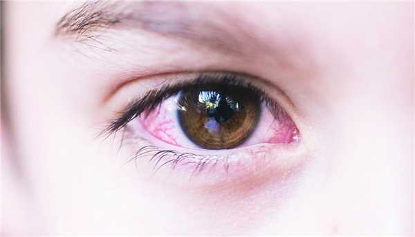 конъюнктивит вирусного типа