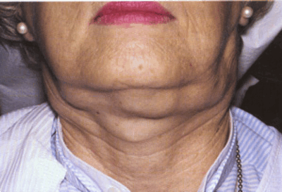 Жизнь с лимфомой