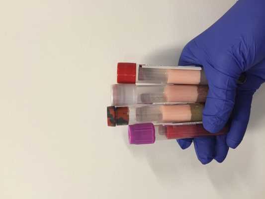 Дислипидемия