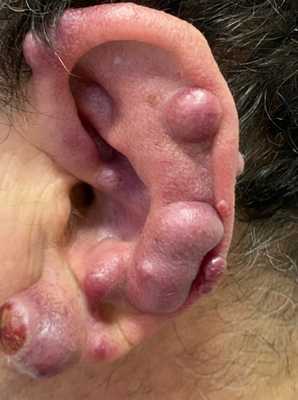 Саркома Капоши