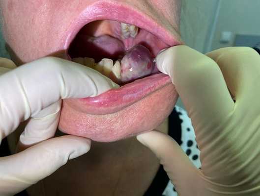 Остеогенная саркома нижней челюсти