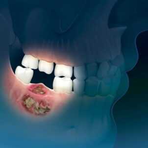 Плоскоклеточный рак нижней челюсти