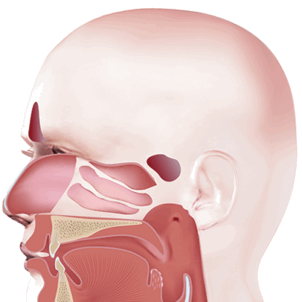 Рак ротоглотки