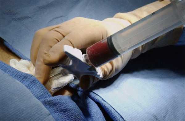 Трансплантация костного мозга