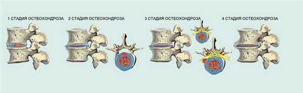 Стадии остеохондроза