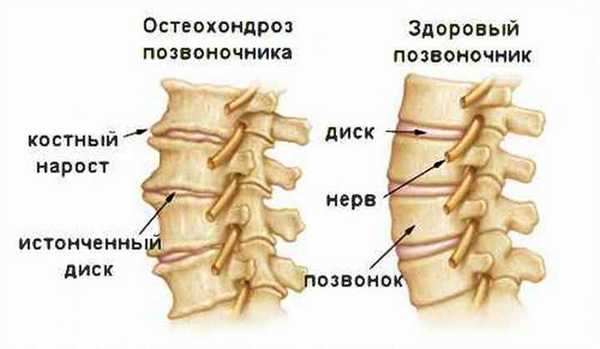 Шейный остеохондроз