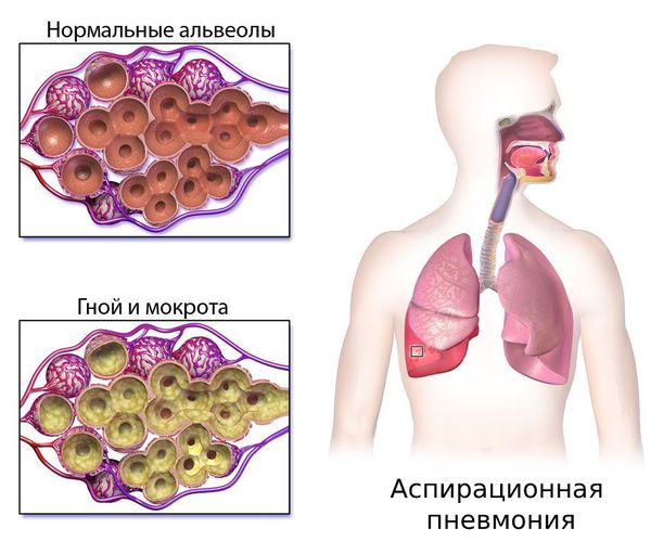 Аспирационная пневмония