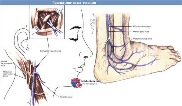 Трансплантаты нервов