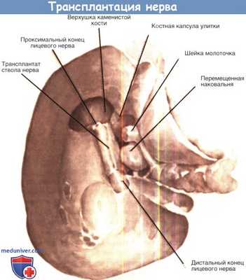 Трансплантация нерва