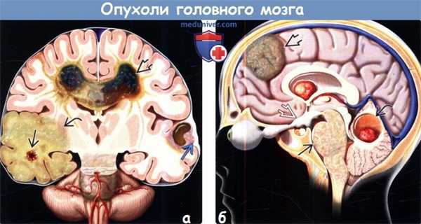 Опухоль астроцитома головного мозга